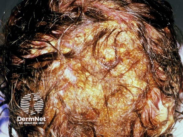 tinea-capitis image from DermNet