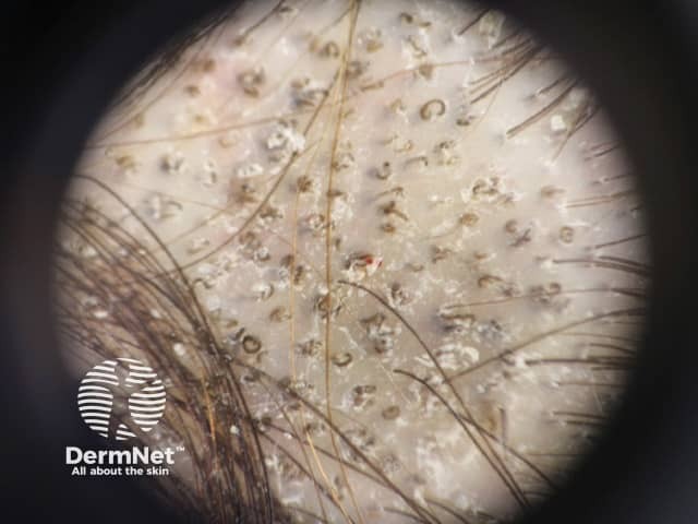 tinea-capitis image from DermNet