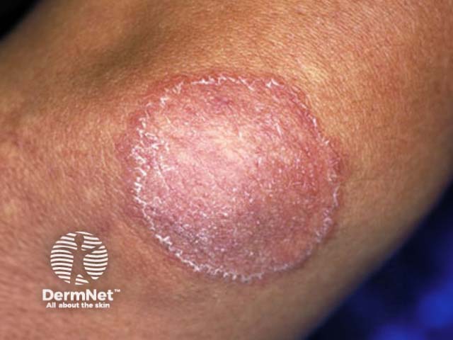tinea-corporis image from DermNet