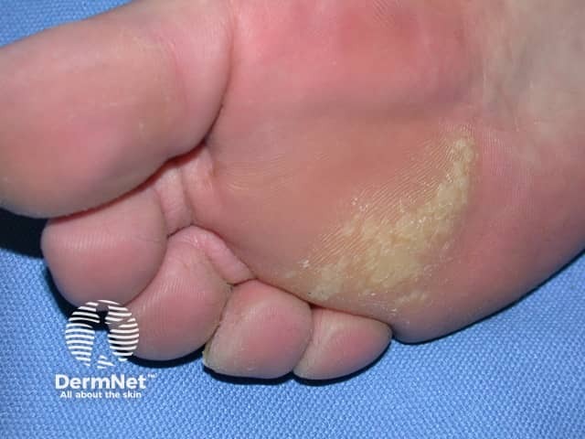 warts image from DermNet