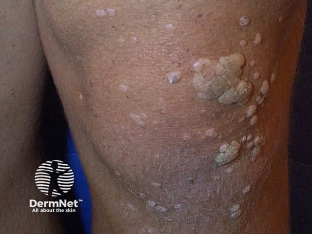 warts image from DermNet