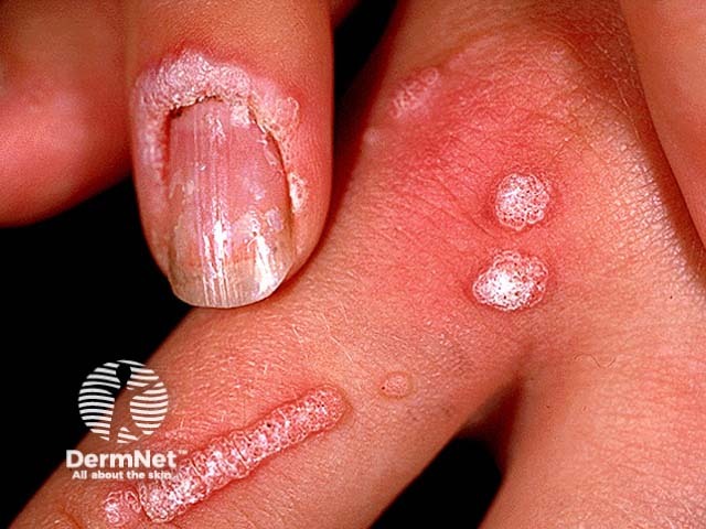 warts image from DermNet