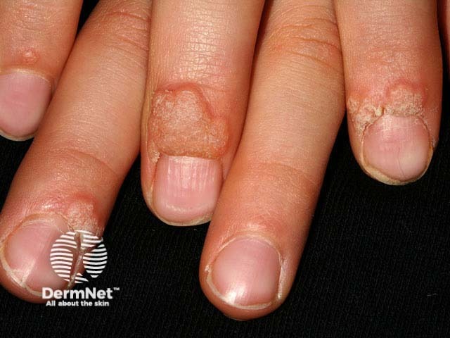 warts image from DermNet