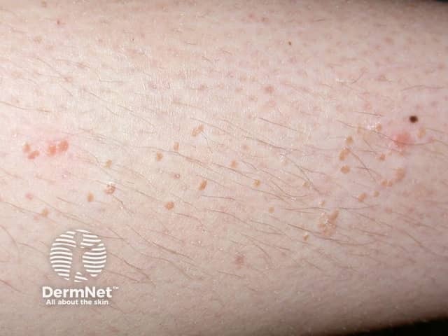 warts image from DermNet