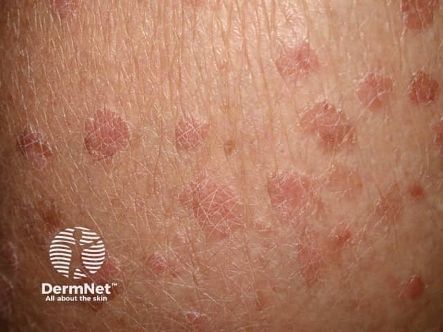 warts image from DermNet