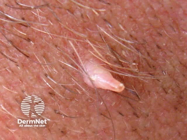 warts image from DermNet