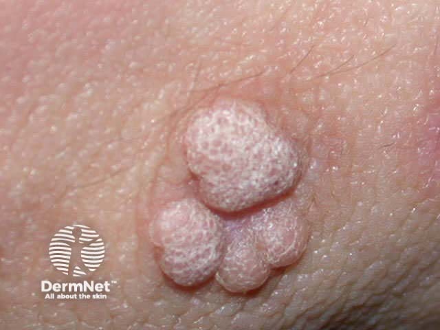 warts image from DermNet